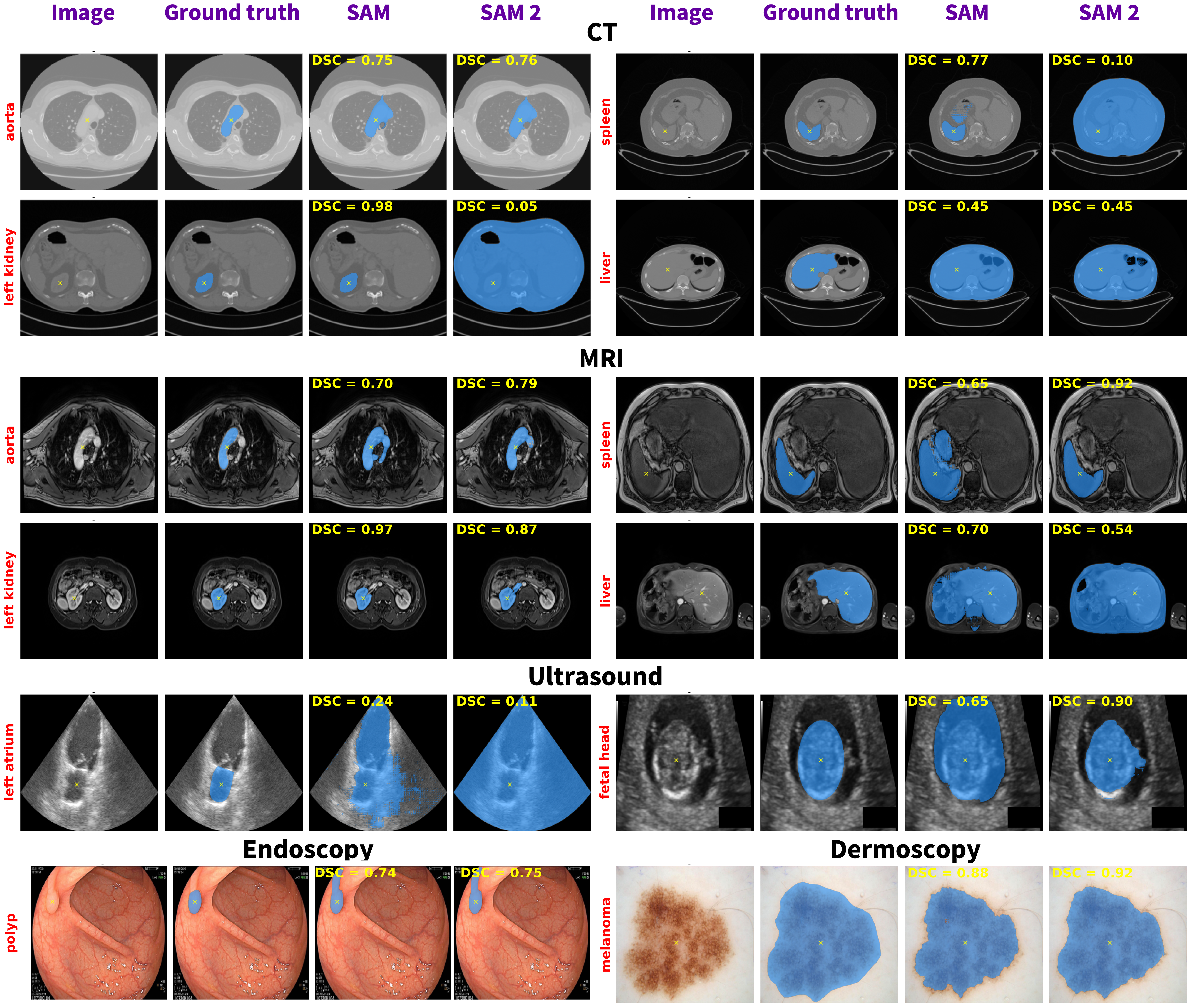 SAM vs SAM2 in medical segmentation